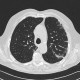 Non-specific interstitial pneumonia, NSIP, interstitial pneumonia: CT - Computed tomography